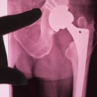 HipImplant